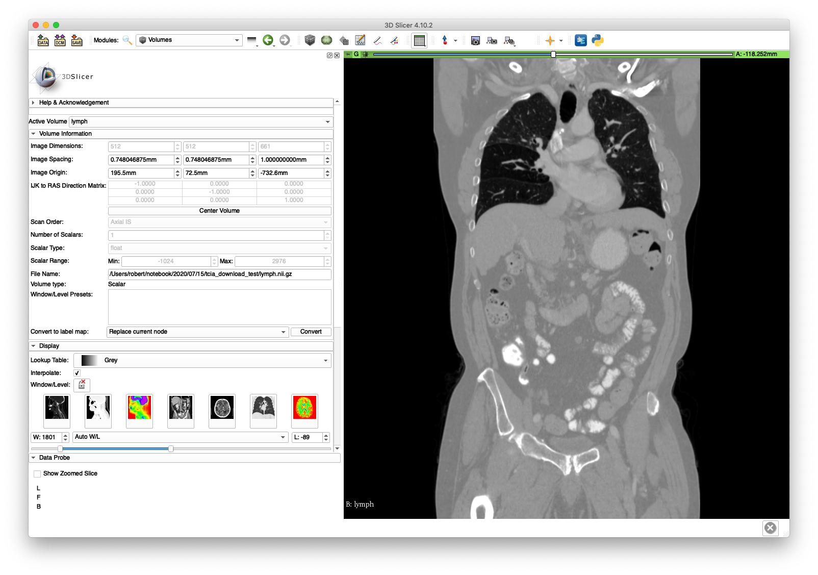 Example 1 Coronal Slice